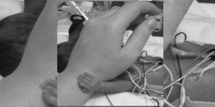 Nevjerojatna fotografija na kojoj nedonošče staro 26 tjedana medicinsku sestru čvrsto drži za ruku