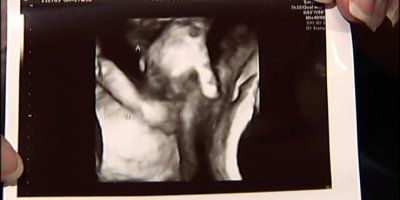 Srcelamajući ultrazvuk: Umirući blizanac drži sestru za ruku