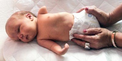 Majka svjedoči čudu nakon što je rodila bebu bez udova