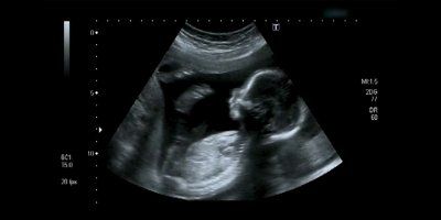 Pogledajte neodoljivu snimku bebe s ultrazvuka koja je oduševila milijune